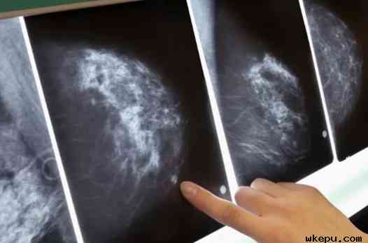 乳腺癌患者可通过基因检测避免无益的化疗